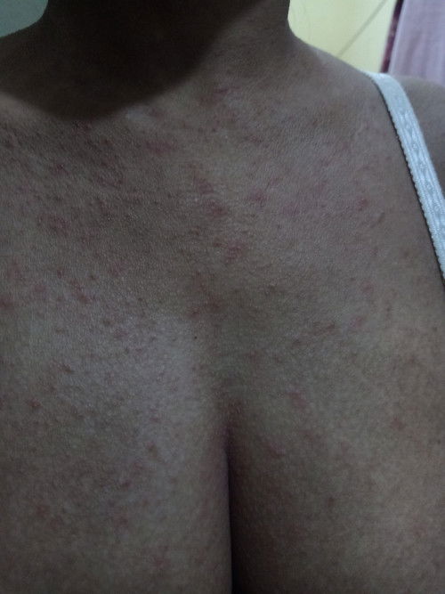 bintik merah seperti biqng keringat