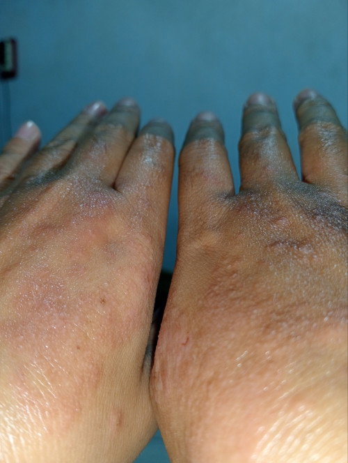 Gatel pada tangan