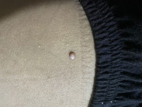 Hi moms. Ano po pwede igamot sa butlig?