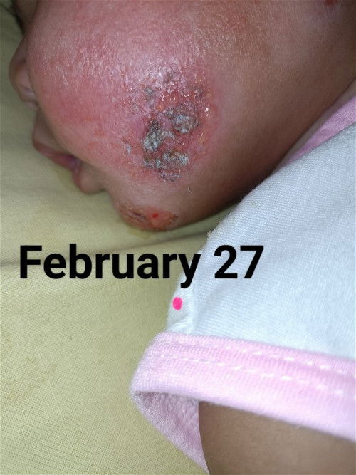 suffering for ECZEMA