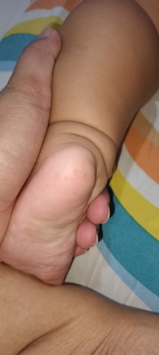 May pantal sa paa c baby