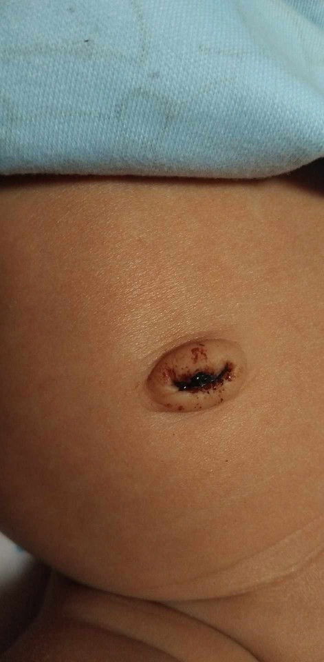 สะดืดหลุดได้6วันแล้วจะเลือดยังออกไม่หยุด