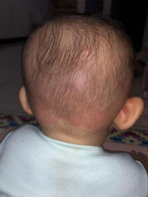 Merah merah pada kulit bayi