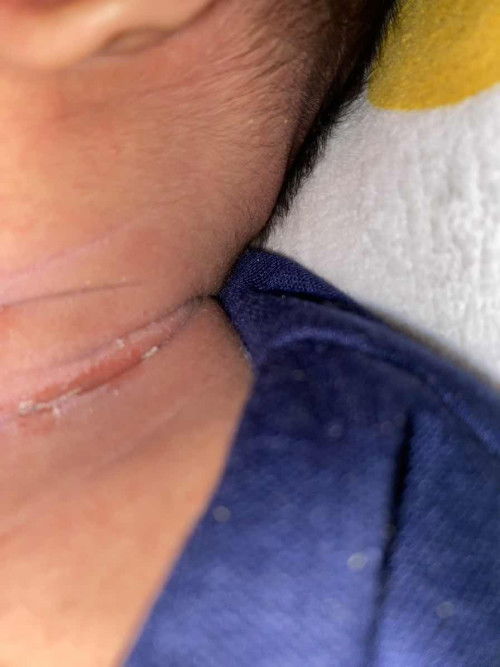 Lecet diarea leher dan selangkang