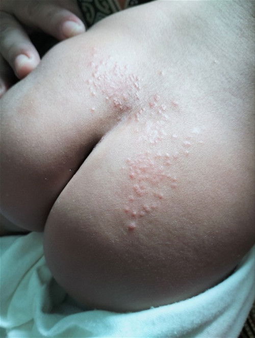 Dermatitis