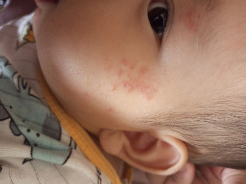 ใช้อะไรถึงจะหายคะ