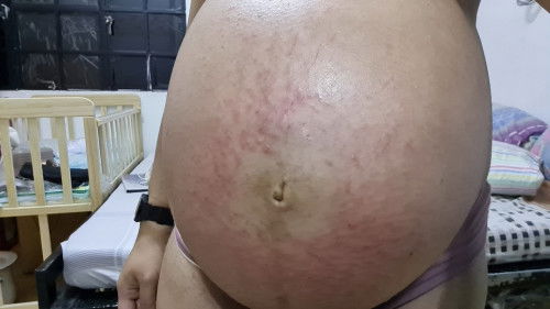 Belly Rashes at 39 weeks