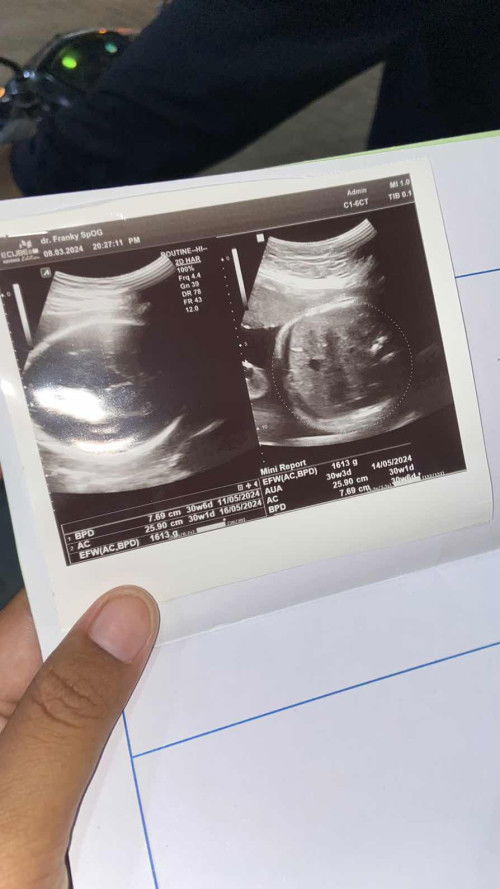 Alhamdulillah 31W. PLASENTA PINDAH KE ATAS, SEBELUMNYA 24W NUTUP BANGET JALAN LAHIR.