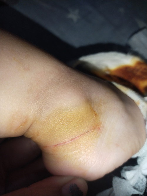 Papa injection ko naba anti-tetanu