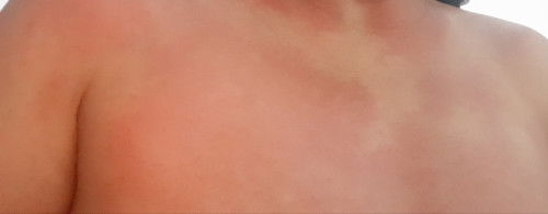 Pagkakaroon ng mga pantal pagkatapos manganak