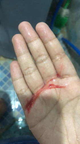 ต้องไปโรงพยาบาลมั้ยคะเเบบนี้