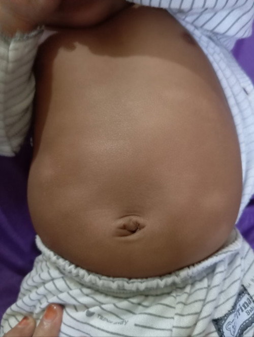 Putih2 kaya panu di perut bayi 3 bln