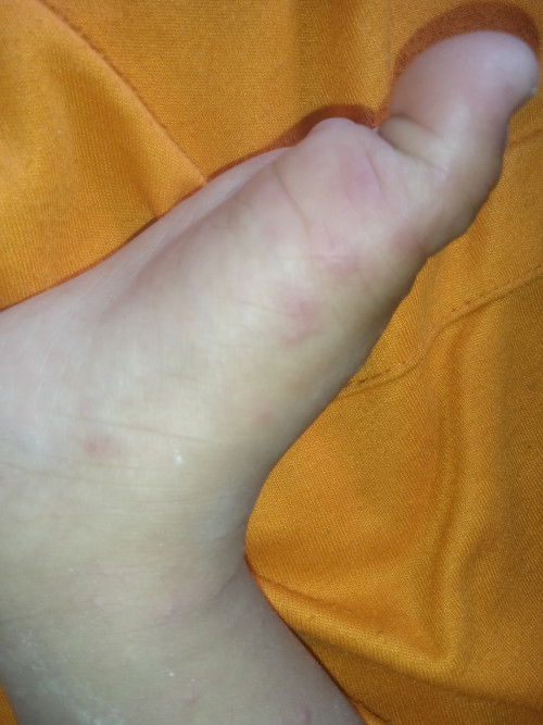 Bintik merah pada bayi