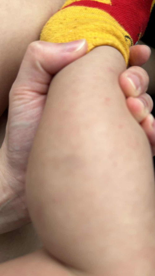 Baby hand n leg rashes