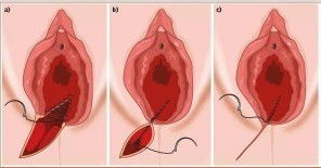 Sa isang NSD ilang days or months bago mawala ang discharge at mag heal ang perineal stitches?