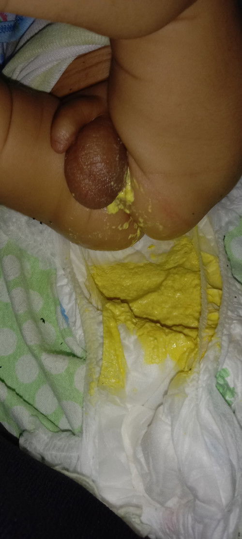 Assalamualaikum bunda mau tanya anak 2bln bab nya gini, kembung jga solusi nya gmn