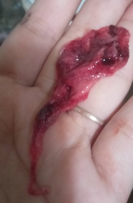Bu mau tanya saat hamil muda tiba" kluar darah dan gumpalan bahaya nggk ya buat janin