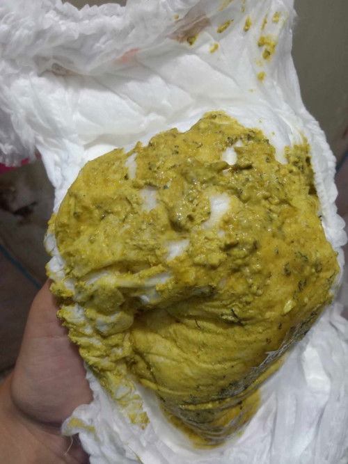 ลูกถ่ายแบบนี้ผิดปกติไหมคะ ลูกคนแรกค่ะ