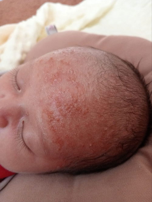 Beruntusan  di jidat sama kepala