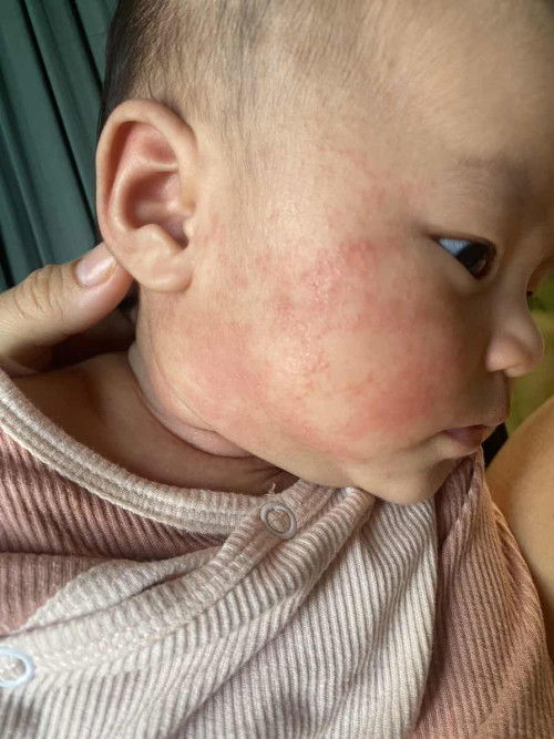 Chàm sữa mẩn đỏ 🌶️