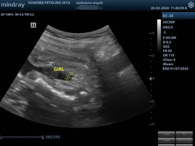 baby gender