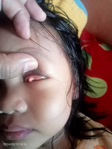 Ada yang tau mata anak saya kenapa,mau periksa tapi tunggu ayahnya pulang kerja