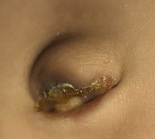 Status po ng pusod ni baby. 1 month old na po sya. Infected na po ba ang ganto? Wala po sya amoy