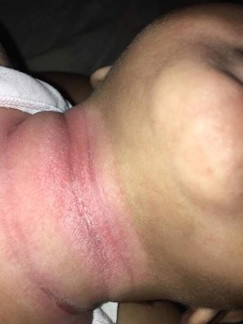 pwede po bang malaman kung anong klase tong rashes at kung ano pong gamot sa ganto?? 4months