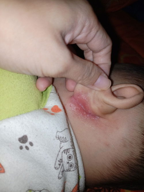 LECET BELAKANG TELINGA