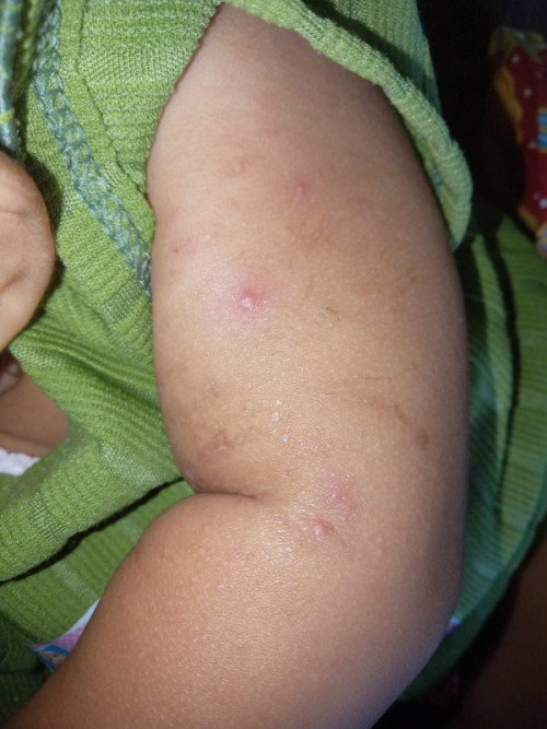 Bunda2 Ada Yg Pernah Ngalamin Ga Bayi 10bulan Gatal2 Bagian Tangan, Solusinya Pakein Apaya