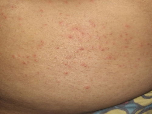 ผื่นแดงตรงท้อง