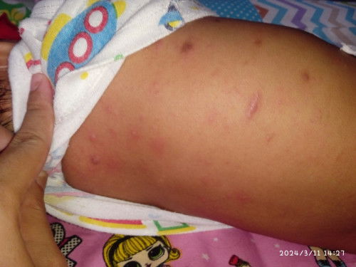 Gatal gatal pada bayi