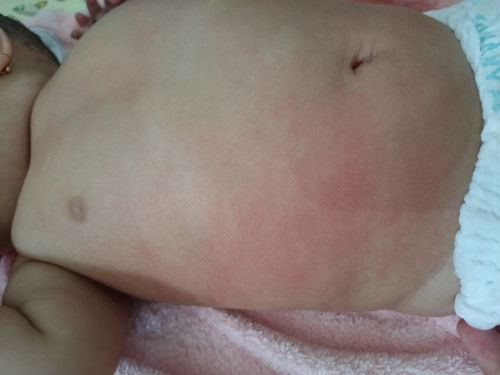 Merah2 pada bayi