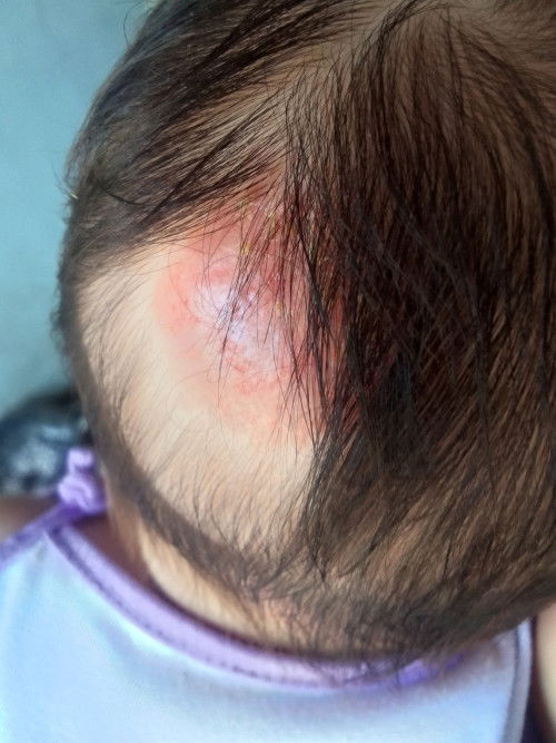 Cradles cap Po ba ito??