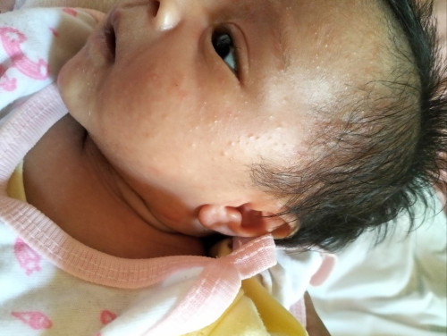 pimple-like sa face ng baby