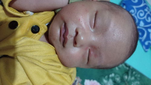 Merah-merah pada muka bayi NB