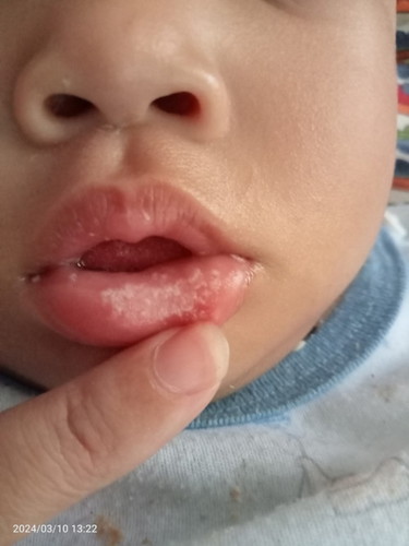 Mulut bercak putih