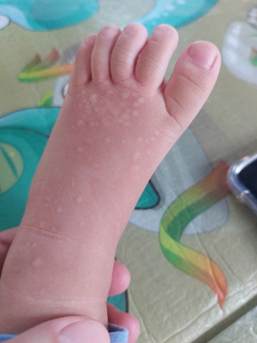 ผื่นคันเกิดจากอะไร