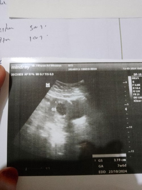 Hpht 2januari trus tdi keluar flek darah..trus aku SDH ke dokter USG Bru ada kantongnya