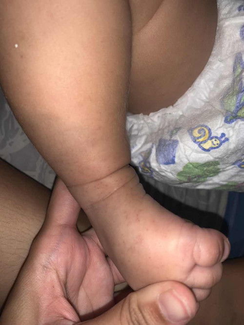bintik merah kecil2 dikaki bayi