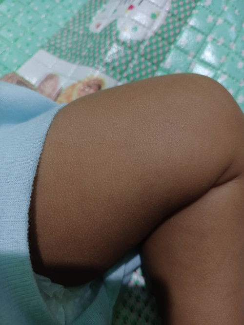 Bintik Putih pada Kulit