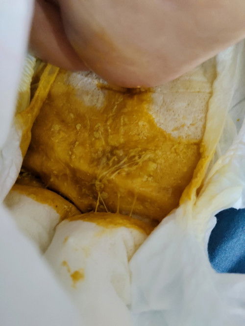 Bé nhà e đi ị phân như này có sao k ạ bé được 1tháng20ngày mà 1 ngày đi nhiều lần phải đến 7-8lượt