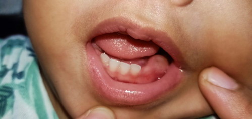 Bukol sa gilagid ng bata