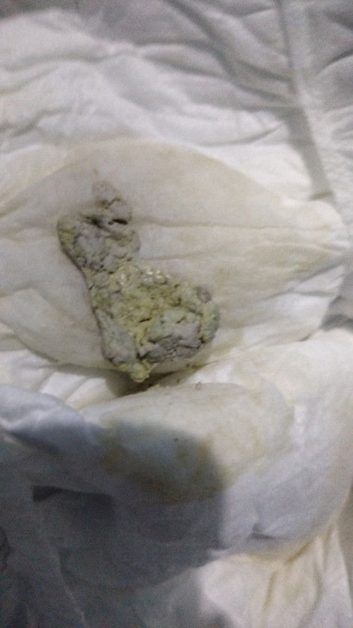 Bun ada yang pup bayi nya seperti ini? bayi saya umur 1 bulan full sufor karna asi saya tidak keluar