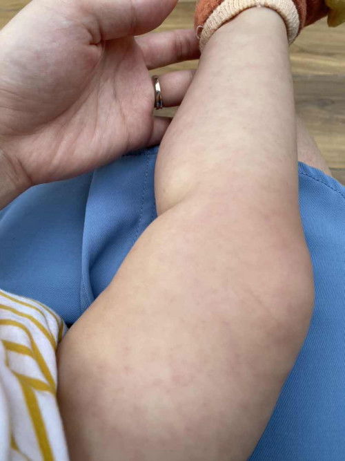 Red spots all over body