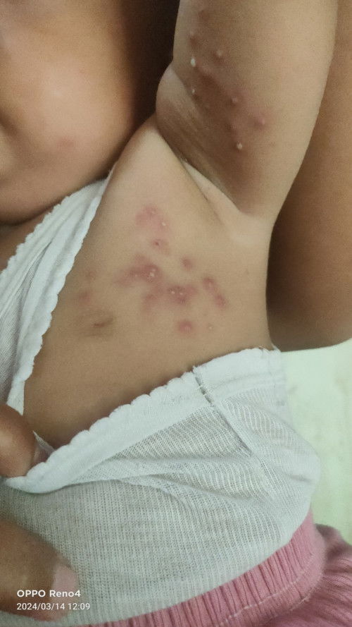 BENTOL MERAH DAN BER NANAH