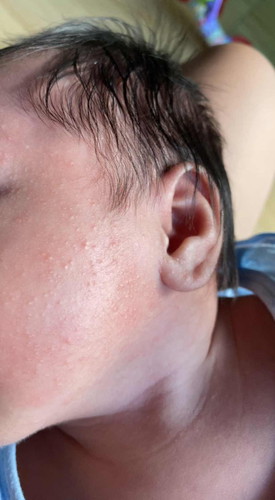 Baby acne?