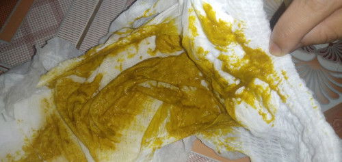 PHÂN TRẺ EM . 
bé 4thg đi ngoài phân như này có sao không ạ . 
#xinkinhnghiem