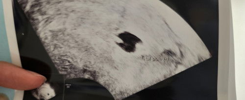 Ada yang pernah di vonis kantong kandungan jelek (irregular)?