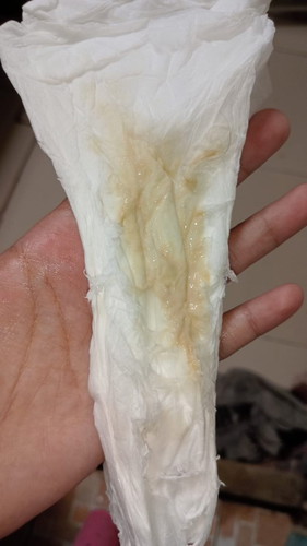 Bunda aku mau tanya kalo keputihan keluar cairan gini terus bahaya ga si,cara obatin nya gmn,